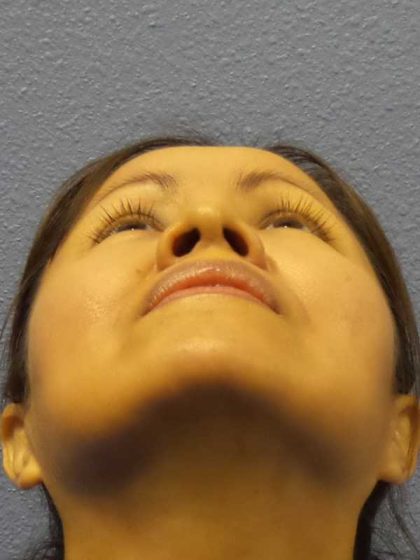 Rhinoplasty Before & After Patient #9913