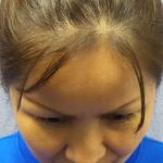 Rhinoplasty Before & After Patient #9913
