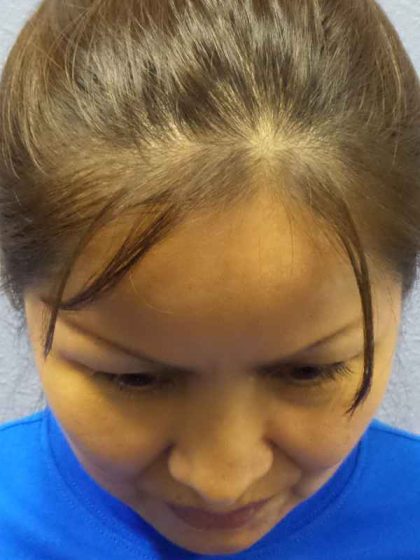 Rhinoplasty Before & After Patient #9913
