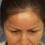 Rhinoplasty Before & After Patient #9913