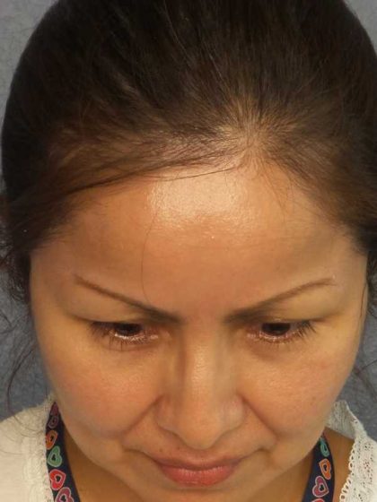 Rhinoplasty Before & After Patient #9913