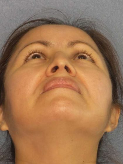 Rhinoplasty Before & After Patient #9913