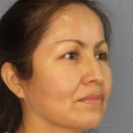 Rhinoplasty Before & After Patient #9913