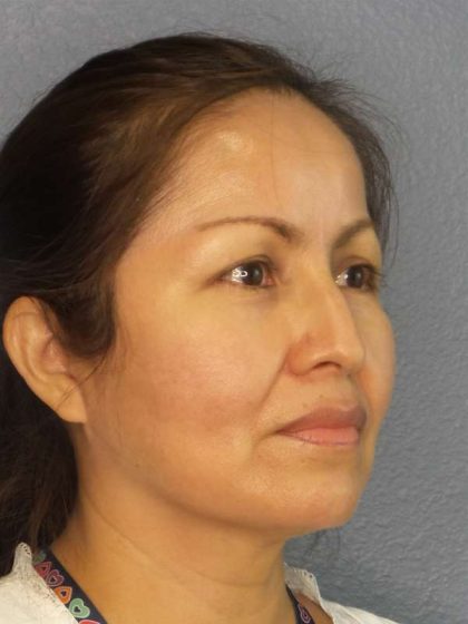 Rhinoplasty Before & After Patient #9913
