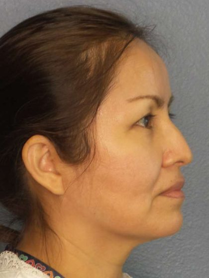 Rhinoplasty Before & After Patient #9913