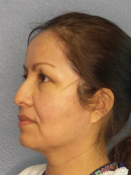 Rhinoplasty Before & After Patient #9913