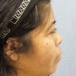 Rhinoplasty Before & After Patient #9807