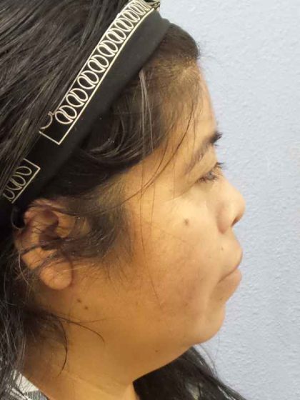 Rhinoplasty Before & After Patient #9807