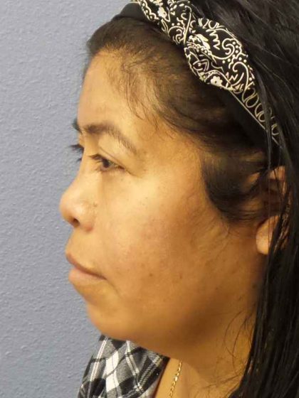 Rhinoplasty Before & After Patient #9807