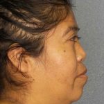 Rhinoplasty Before & After Patient #9807