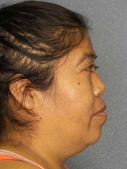 Rhinoplasty Before & After Patient #9807
