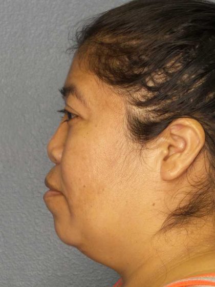 Rhinoplasty Before & After Patient #9807