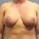 Breast Lift with Implant (Augmentation Mastopexy) Before & After Patient #4082