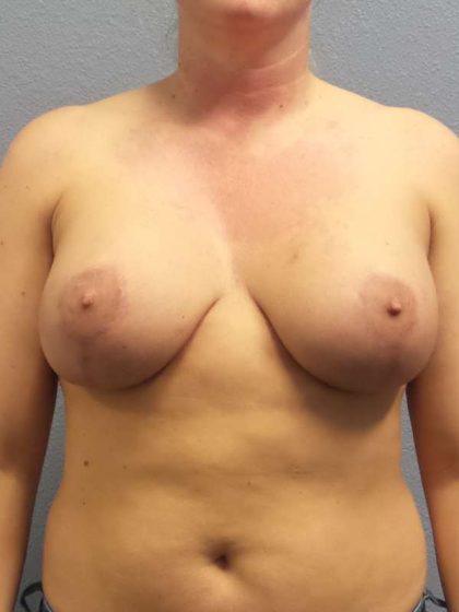 Breast Lift with Implant (Augmentation Mastopexy) Before & After Patient #4082