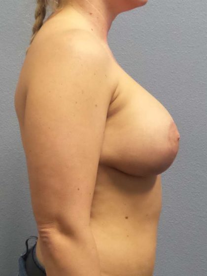 Breast Lift with Implant (Augmentation Mastopexy) Before & After Patient #4082