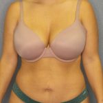 Abdominoplasty Before & After Patient #3865
