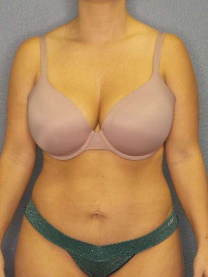 Abdominoplasty Before & After Patient #3865