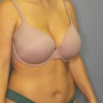Abdominoplasty Before & After Patient #3865