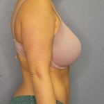 Abdominoplasty Before & After Patient #3865