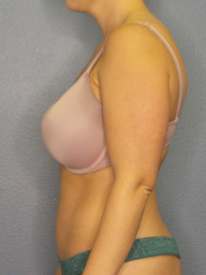 Abdominoplasty Before & After Patient #3865