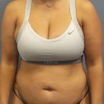 Abdominoplasty Before & After Patient #3865