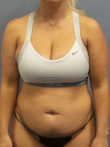 Abdominoplasty Before & After Patient #3865