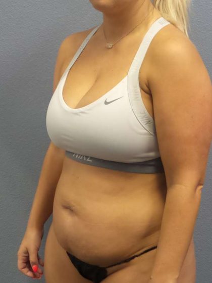 Abdominoplasty Before & After Patient #3865