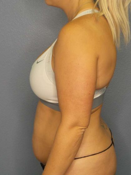 Abdominoplasty Before & After Patient #3865