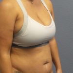 Abdominoplasty Before & After Patient #3865