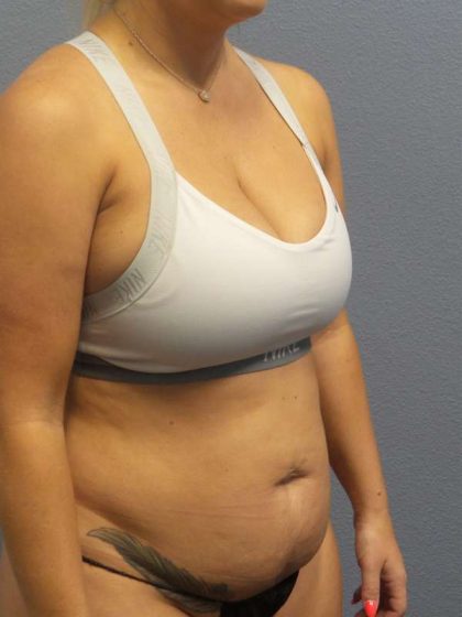 Abdominoplasty Before & After Patient #3865