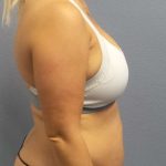 Abdominoplasty Before & After Patient #3865