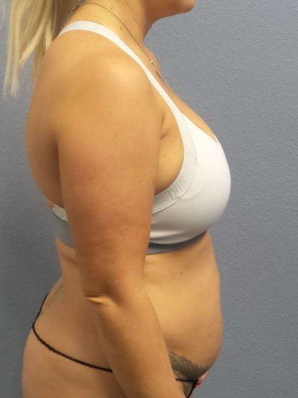 Abdominoplasty Before & After Patient #3865