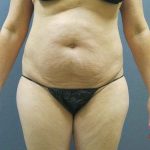 Liposuction Female Before & After Patient #8082