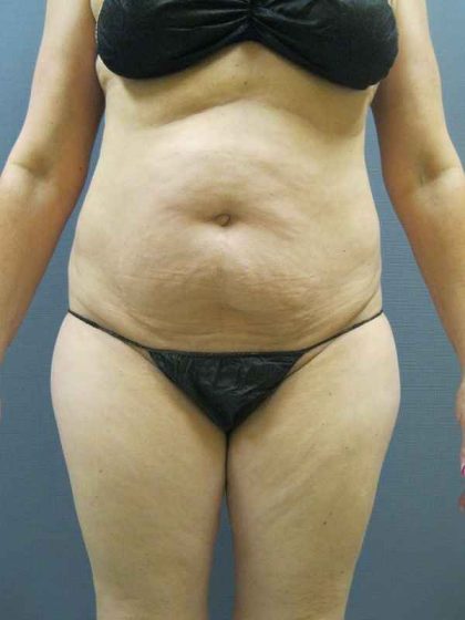 Liposuction Female Before & After Patient #8082