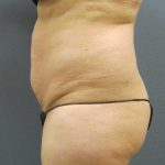 Liposuction Female Before & After Patient #8082