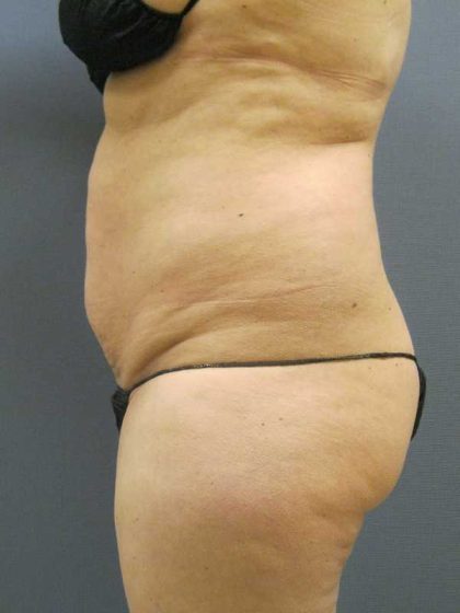Liposuction Female Before & After Patient #8082