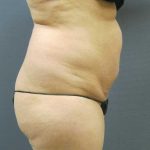 Liposuction Female Before & After Patient #8082