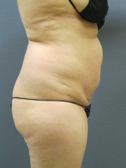 Liposuction Female Before & After Patient #8082