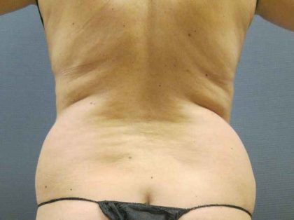 Liposuction Female Before & After Patient #8082