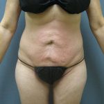 Liposuction Female Before & After Patient #8082