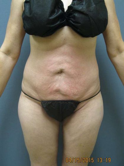 Liposuction Female Before & After Patient #8082
