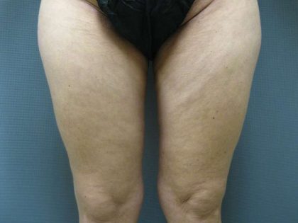 Liposuction Female Before & After Patient #8082