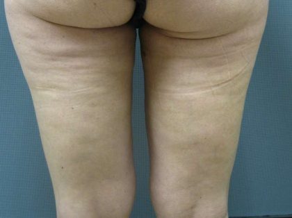 Liposuction Female Before & After Patient #8082