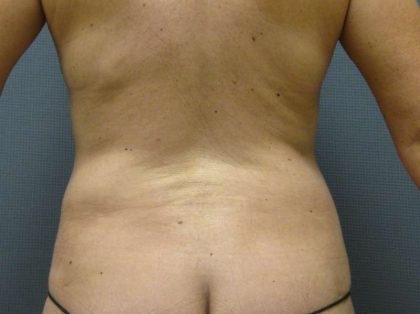 Liposuction Female Before & After Patient #8082