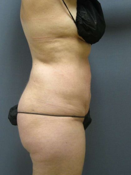 Liposuction Female Before & After Patient #8082