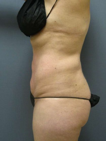 Liposuction Female Before & After Patient #8082