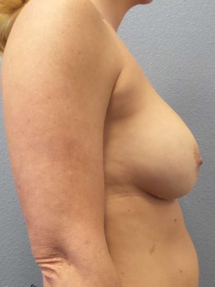 Breast Augmentation Before & After Patient #5554