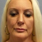 Rhinoplasty Before & After Patient #9770