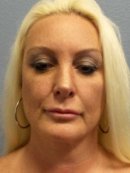 Rhinoplasty Before & After Patient #9770
