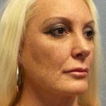 Rhinoplasty Before & After Patient #9770